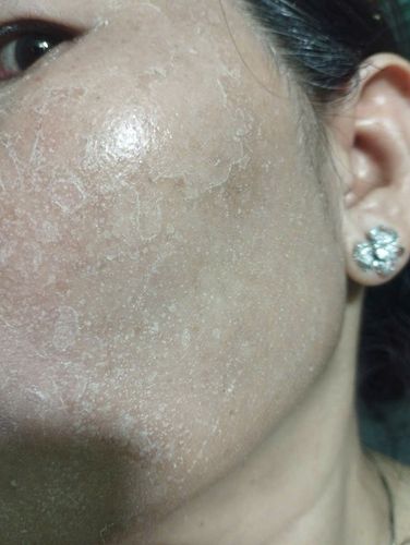 PEEL CÓ LÀM MỎNG DA?